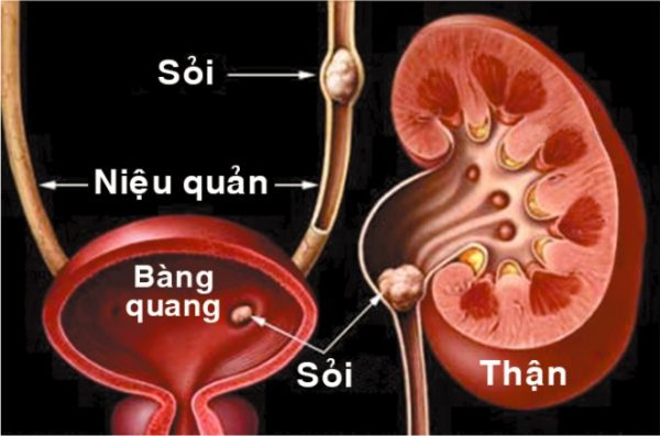 Sỏi đường tiết niệu gây tiểu rắt tiểu buốt