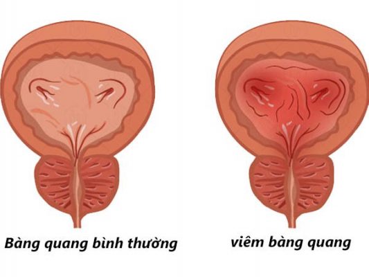 chữa viêm bàng quang bằng lá mã đề