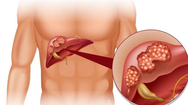 cà gai leo chữa viêm gan, xơ gan, hỗ trợ chống ung thư gan