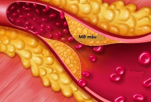 Rượu bia ảnh hưởng không nhỏ tới cholesterol trong máu