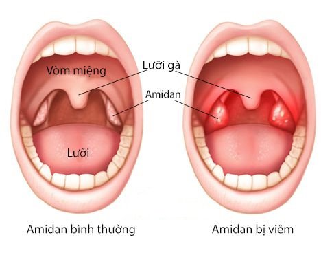 Viêm amidan xuất hiện ở mọi độ tuổi