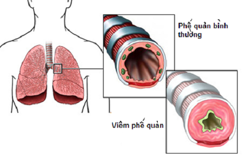 Viêm phế quản