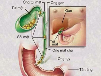 Sỏi mật gây vàng da