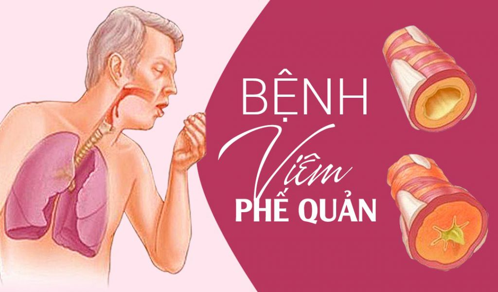 Điều trị viêm phế quản