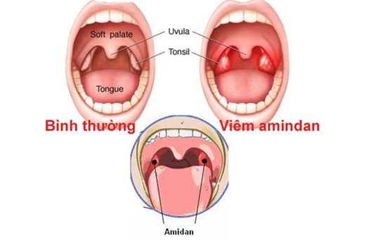 Hình ảnh Amidan khi bị viêm