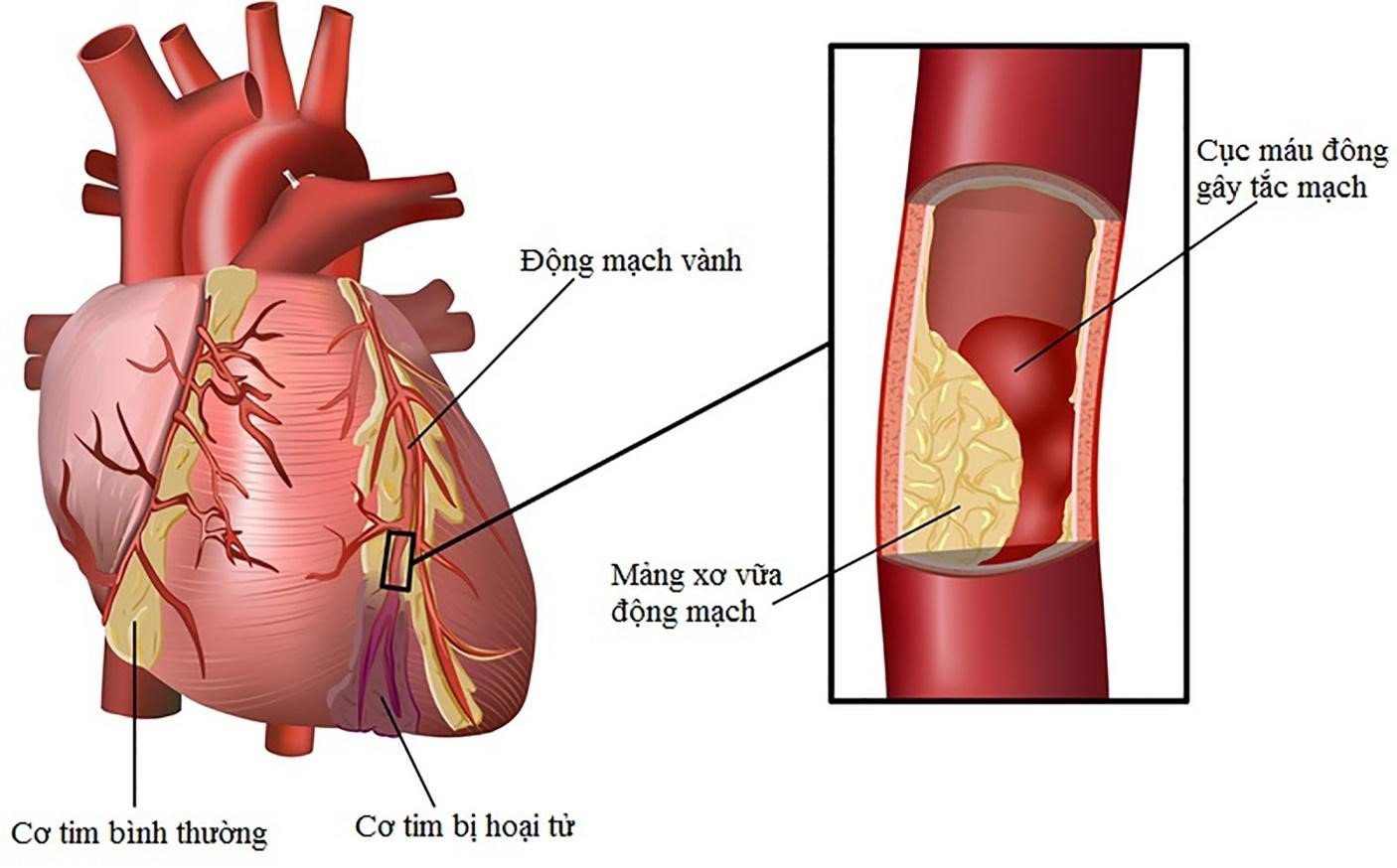 Hiện tượng rối loạn mỡ máu nếu kéo dài sẽ gây xơ vữa động mạch và tắc huyết khối