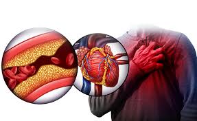 Nếu cứ liên tục để cho rối loạn mỡ máu ngày càng nặng cũng sẽ dẫn đến các nguy cơ về tim mạch