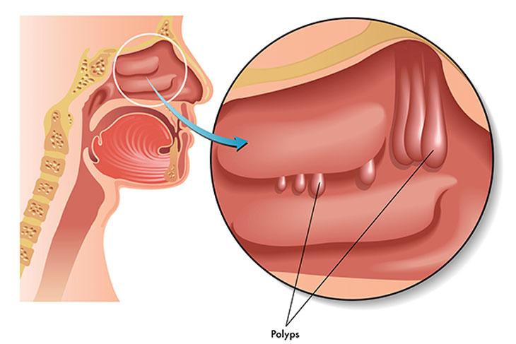 viêm họng hạt cũng có thể xảy ra do viêm xoang và polyp mũi