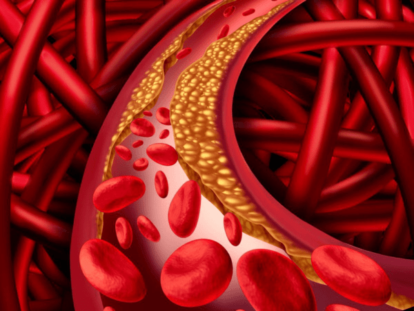 Rối loạn chuyển hóa lipid máu hay còn gọi là rối loạn mỡ máu là bệnh lý khá phổ biến và đang có xu hướng gia tăng