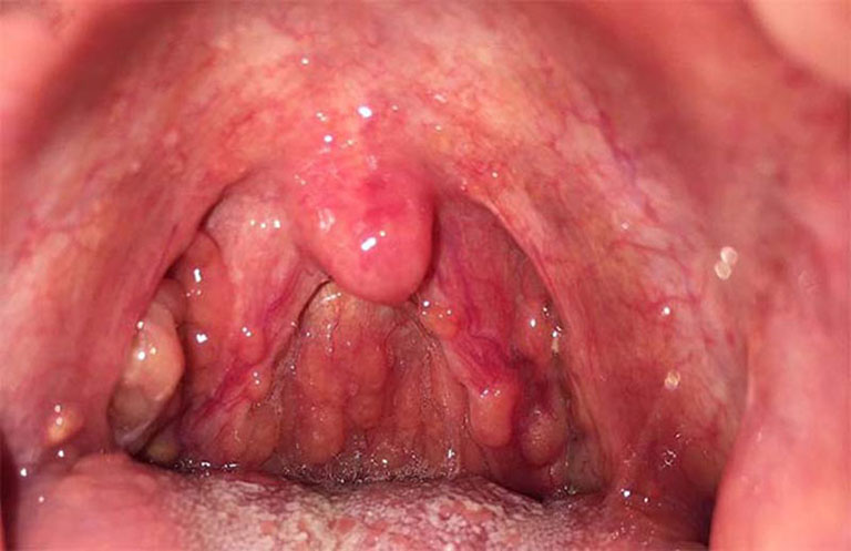 Viêm họng hạt là gì? Nguyên nhân? Cách điều trị