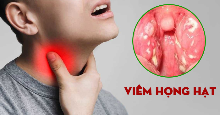 Viêm họng hạt dễ tái phát, tại sao?